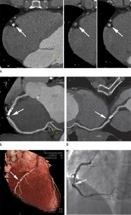 питание при кальцинозе коронарных артерий. кальциноз магистральных сосудов. кальциноз коронарных артерий на кт. кальциноз атеросклеротической бляшки артерий. кальций коронарные артерии.