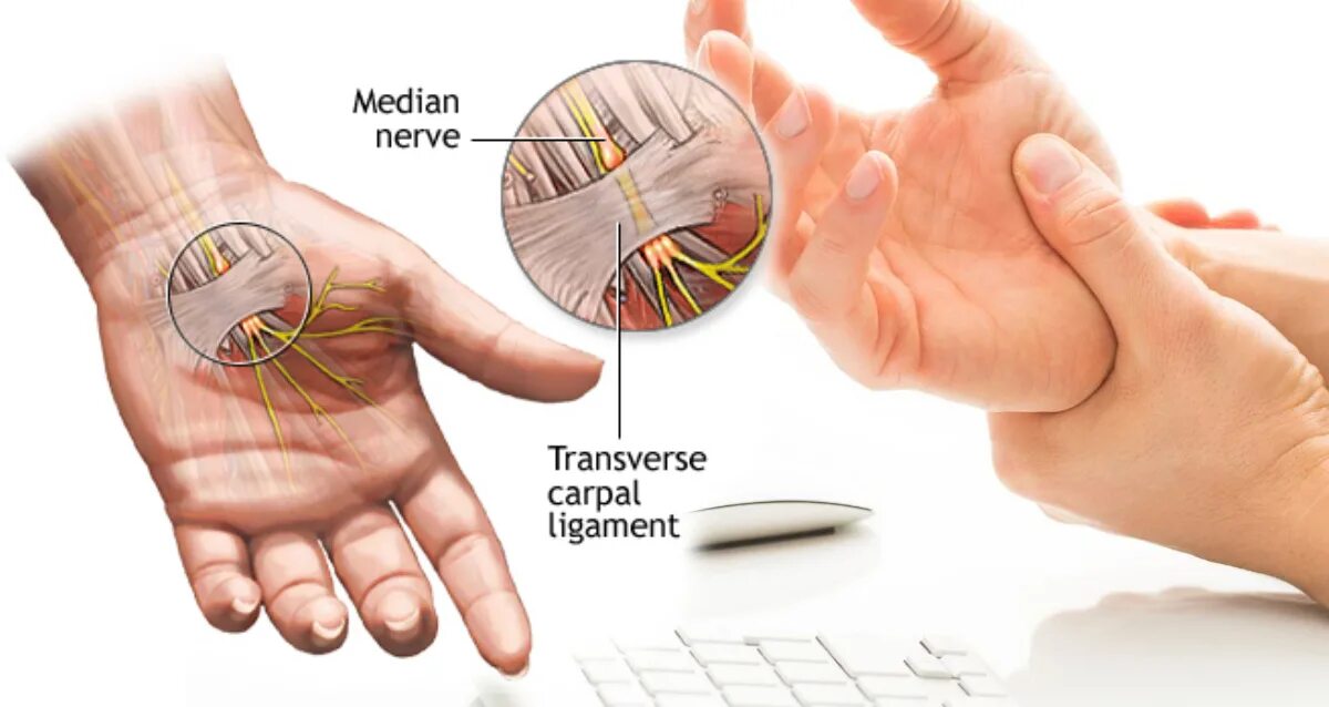 Туннельный синдром запястья. Туннельный синдром локтевого нерва ортез. Карпальный туннельный синдром.