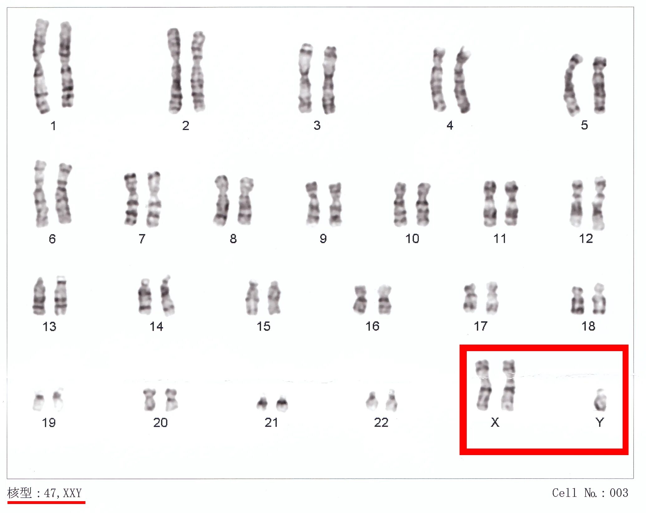 Xxy хромосома. Синдром Клайнфельтера кариотип. Филадельфийская хромосома кариотипа человека. Клайнфелтер кариотип.