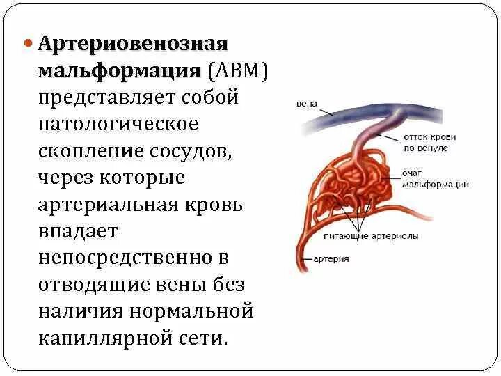 Сосудистая аномалия. АВМ классификация венозные мальформации. Артериовенозные мальформации сосудов головного мозга. Артериально венозная мальформация сосудов. Симптомы артериовенозной мальформации.