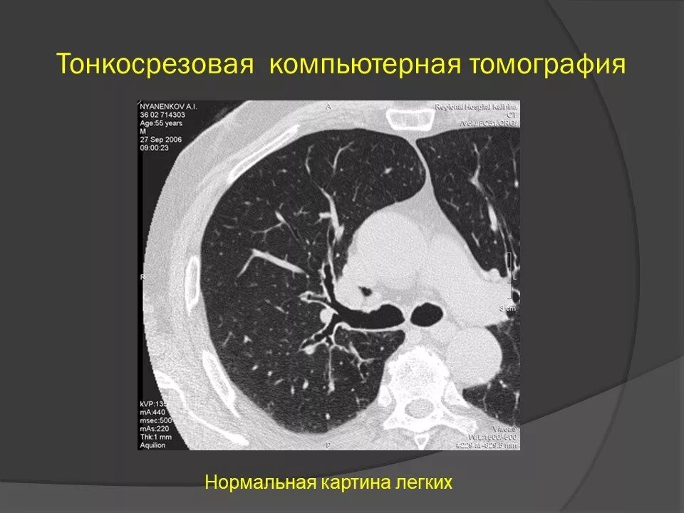 Срезы на кт легких. Срезы кт. Поперечный срез кт. Кт брюшной полости аксиальный срез. Аксиальный срез кт.
