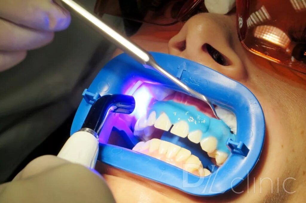 Лазерное отбеливание зубов. Профессиональная гигиена полости рта. Стоматология отбеливание.