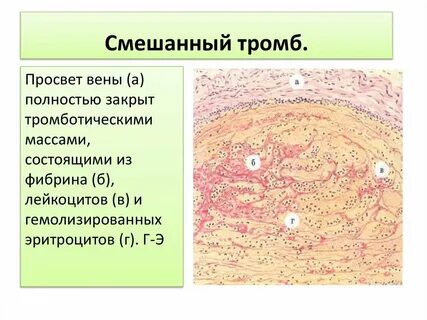 Особенности строения тромбов