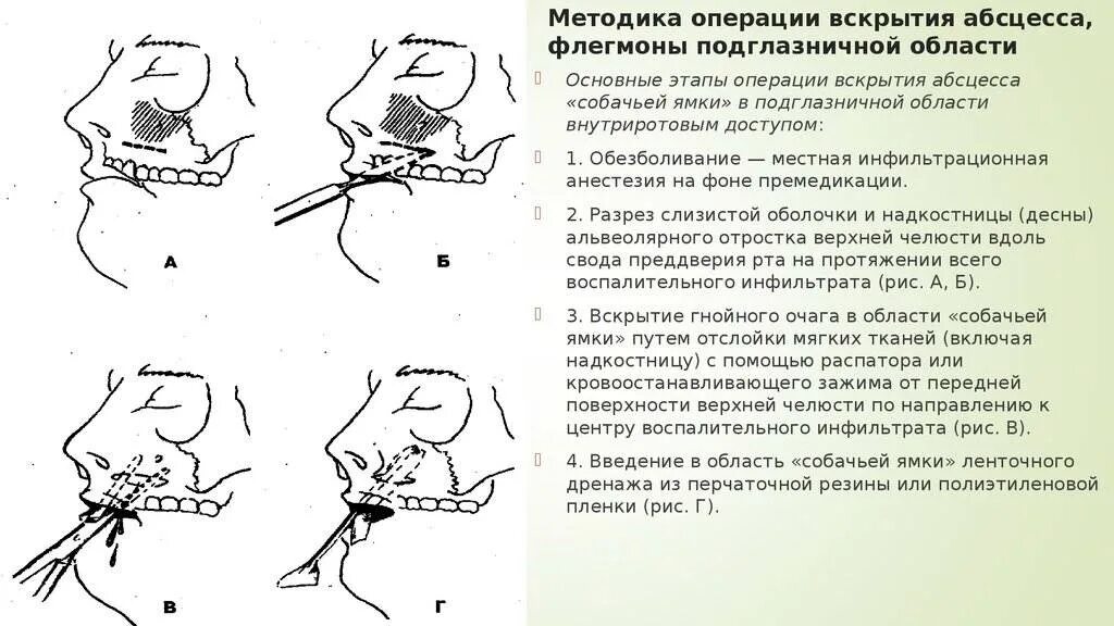 Дренирование гнойны ран. Вскрытия абсцесса, флегмоны подглазничной области. Хирургическое лечение флегмоны подглазничной области. Вскрытие абсцесса подглазничной области. Операция вскрытия абсцесса и флегмоны подглазничной области..