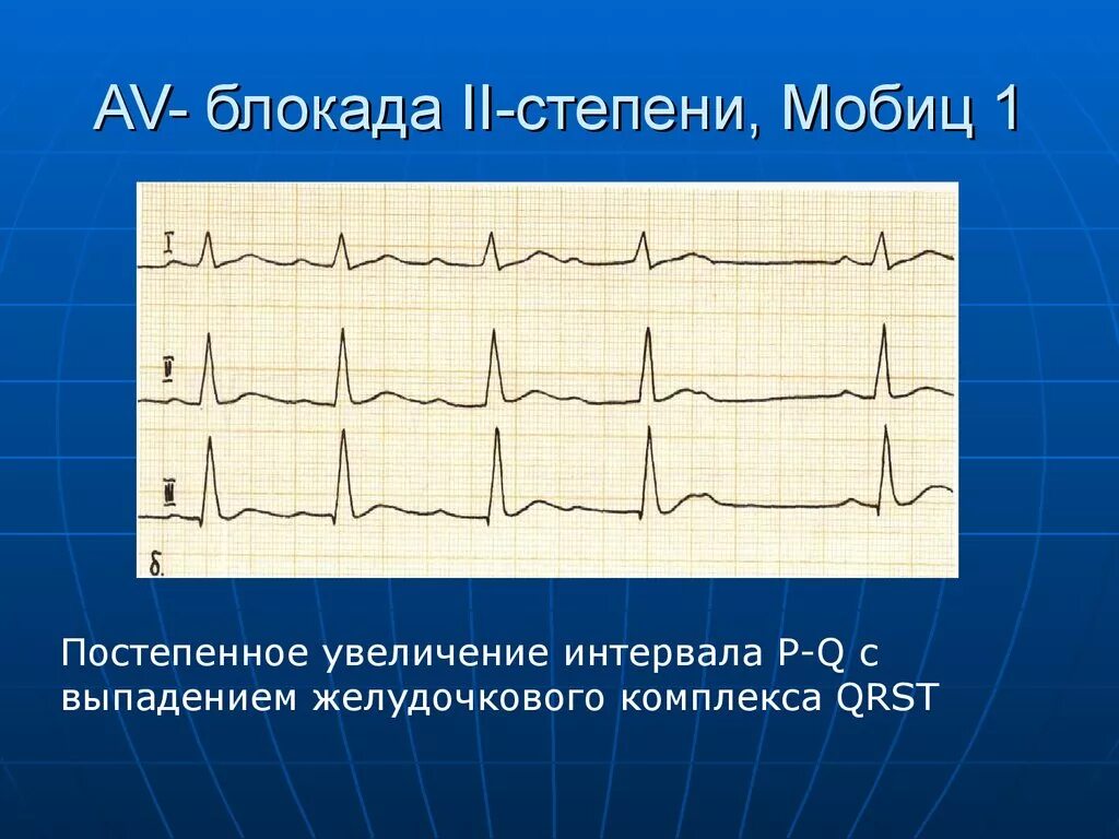 Комплекс блокада. Av блокада 1 степени Мобиц 1 ЭКГ. Атриовентрикулярная блокада Мобиц 1 ЭКГ. Синоатриальная блокада Мобиц 2. Av блокада 2 степени Мобитц 1 на ЭКГ.