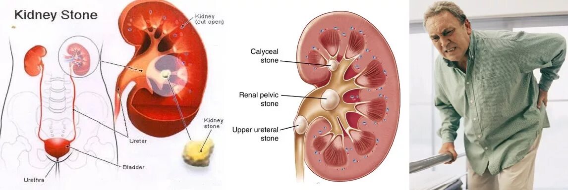 Камень больно. Мочекаменная болезнь урология. Камни в почках физиология. Камни почечных канальцах. Мочекаменная болезнь где болит.