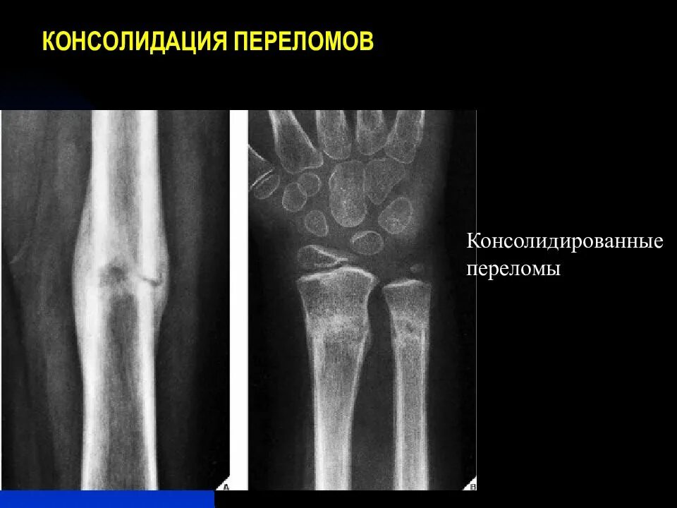 Что такое консолидация перелома. Консолидация кости при переломе. Консолидация перелома рентген. Стадии консолидации перелома на рентгене. Консолидация большеберцовой кости.