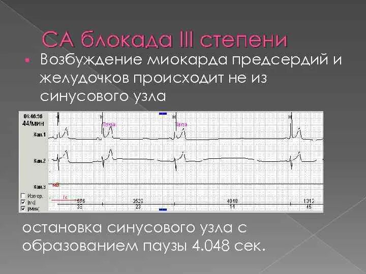 Синус арест и синоатриальная блокада 3 степени. Синоатоикллгая блокада 3 степени. Синусоартерипльная блокада 3 степени. Блокада са узла ЭКГ. Са блокада степени