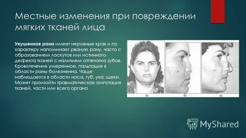 Ротация лоскута на ножке со щеки. Пластика мышечным лоскутом на питающей ножке. Пласт или лоскут свежего. Мостовидная кожная пластика. Хлопок весовой лоскут.