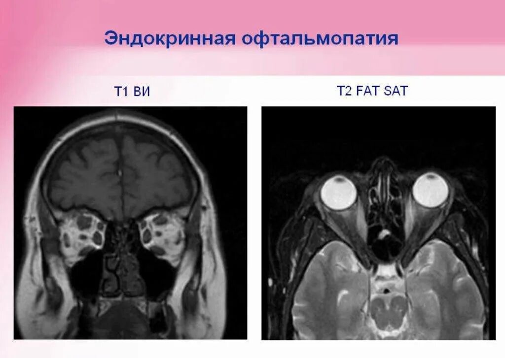 Пульс терапия при эндокринной офтальмопатии. Кт орбит при эндокринной офтальмопатии. кт орбит экзофтальм. экзофтальм кт мрт.