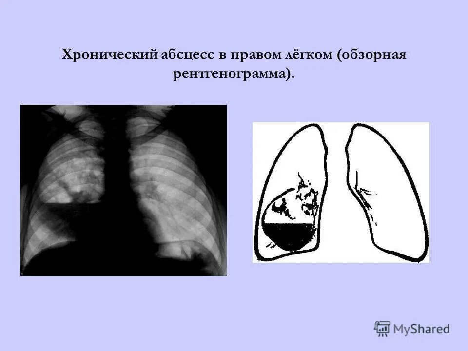 Абсцесс легкого причины