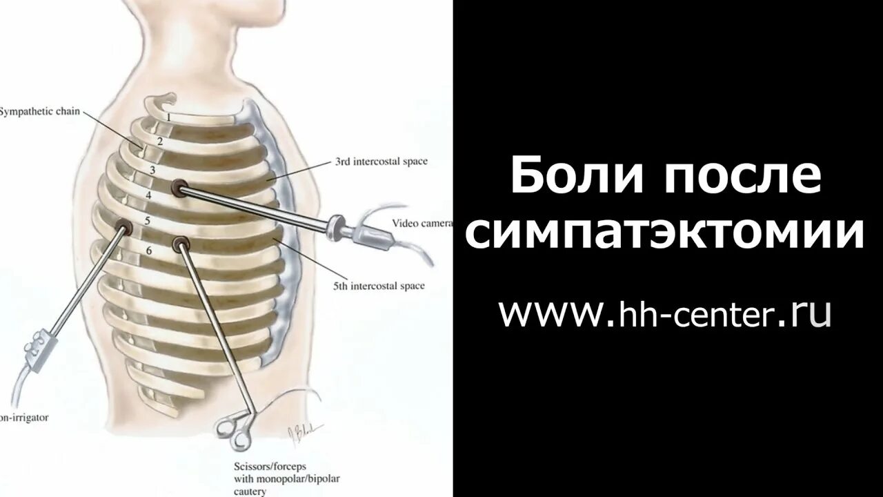 Симпатэктомия цена. Торакоскопическая грудная симпатэктомия. Поясничная симпатэктомия. Эндоскопическая торакальная симпатэктомия. Эндоскопическая поясничная симпатэктомия.