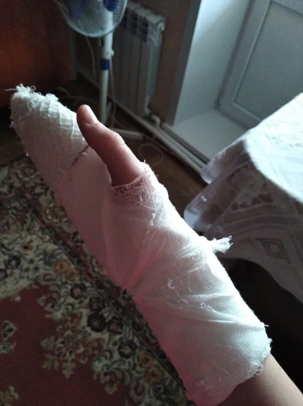 Хожу с гипсом на руке. Перелом мизинца на руке гипс. загипсованная сломанная рука.