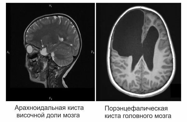 Височная киста головного мозга. Порэнцефалическая киста головного мозга кт. Арахноидальная киста кт. Киста височной доли кт.