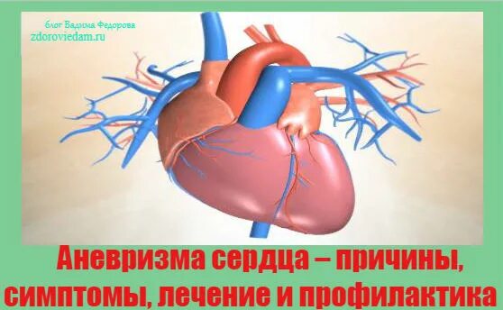 Аневризма сердца что это такое симптомы. Аневризмы сосудов сердца. Лекарство от аневризмы сердца. Симптомы при аневризме сердца.