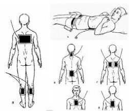 Гальванизация расположение электродов. Схема расположения электродов для электрофорезе Элфор. Электрофорез на плечевой сустав. Электрофорез с эуфиллином на грудную клетку схема. Электрофорез с эуфиллином на позвоночник