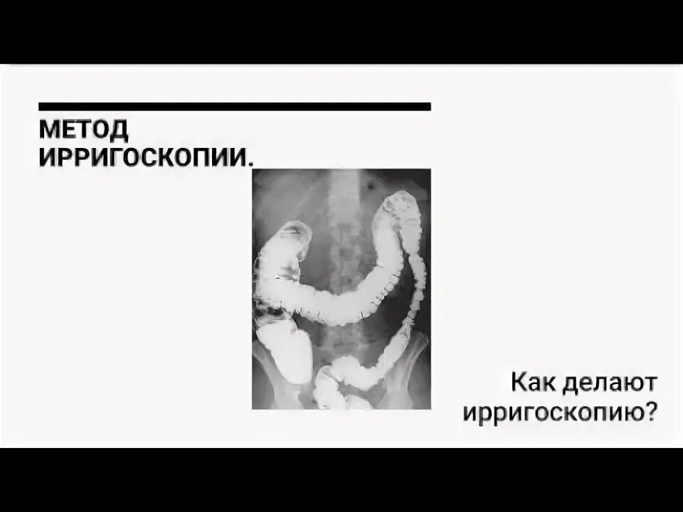 Ирригоскопия как проводится видео. Ирригоскопия прямой кишки. ирригоскопия ход процедуры. ирригография ирригоскопия методика показания. ирригоскопия кишечника в казани.