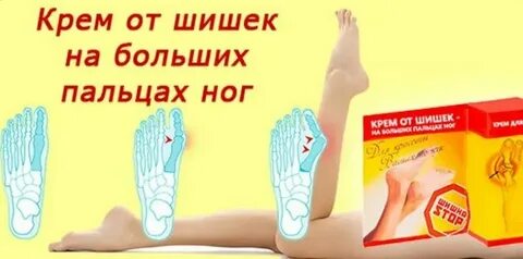 Лечение шишек стопы