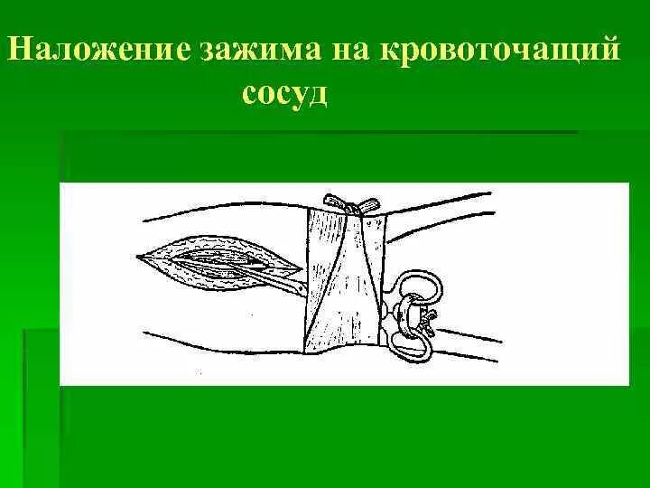 Тампонада раны при кровотечении. Наложение зажима на кровоточащий сосуд. Наложение кровоостанавливающего зажима. Наложение зажима в ране. Техника наложения кровоостанавливающего зажима.