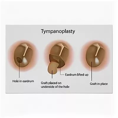 Тимпанопластика отзывы. 1 Тип тимпанопластики этапы.