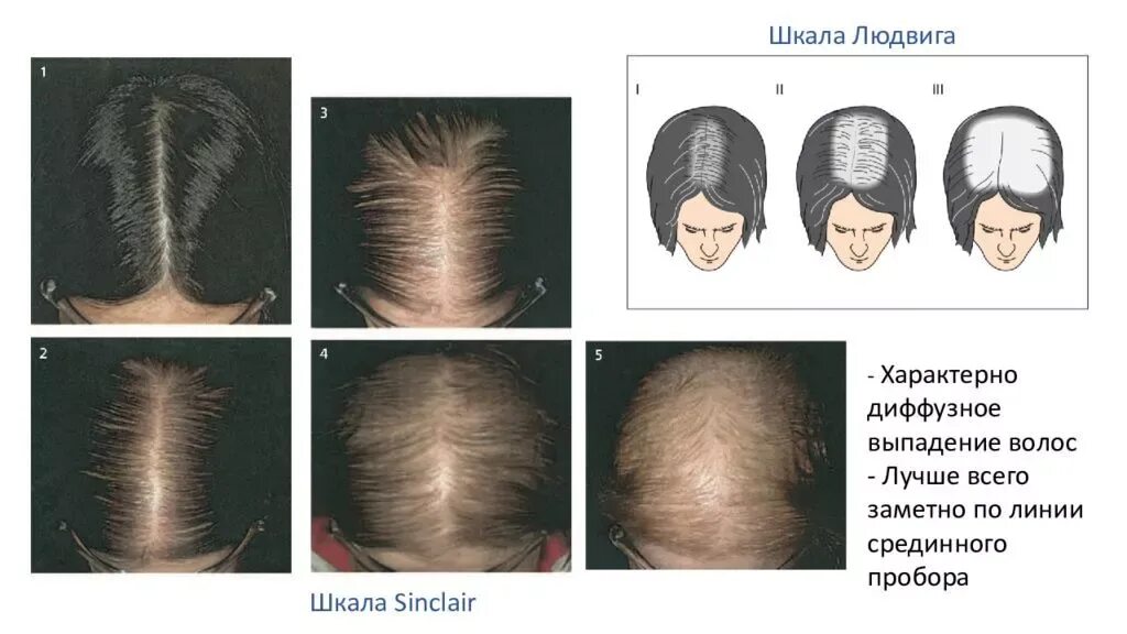 Диффузно андрогенная. Шкала людвига алопеция. андрогенетическая алопеция шкала людвига. андрогенная алопеция алопеция. андрогенная алопеция до и после.