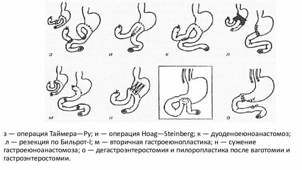 Операция пота. Гастроеюноанастомоза по ру. операция бильрот 1 схема операции. синдром приводящей петли операция по ру. дуоденодуоденоанастомоз схема.