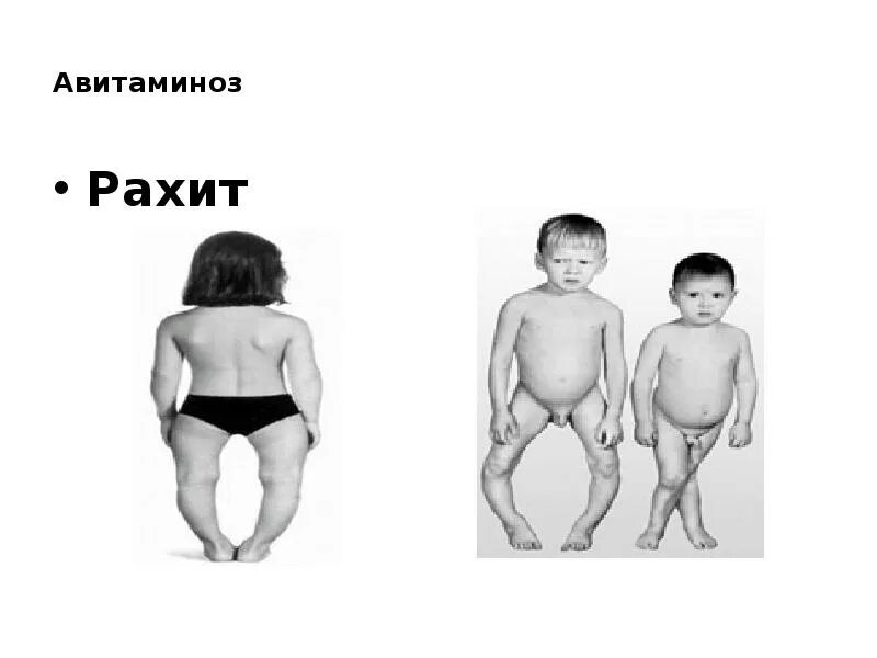 Рахит 6 лет. Патогенез рахита.