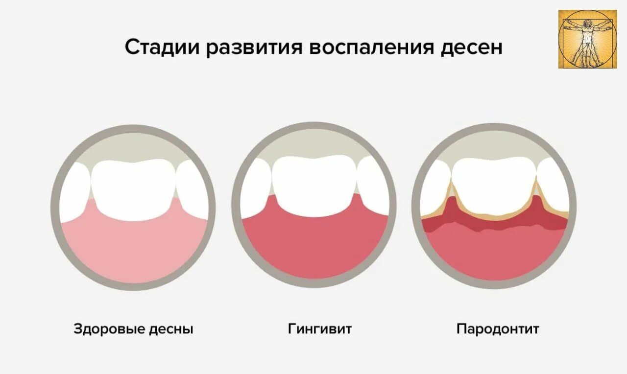 Почему кровь из зубов. Кровоточивость десен гингивит. Стадии развития воспаления десен.