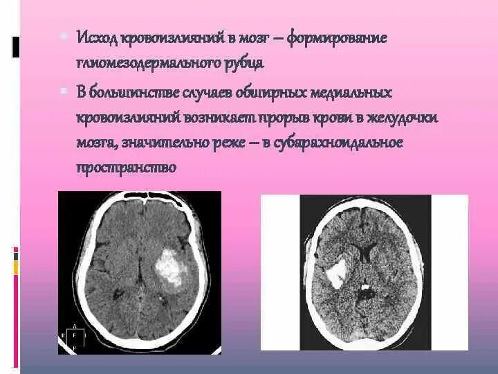 Кровоизлияние в желудочки. Кровоизлияние в мозг исход. Исход кровоизлияния в головной мозг. Тсхлды кровоизлияния в мозг. Осложнения при кровоизлиянии в мозг.