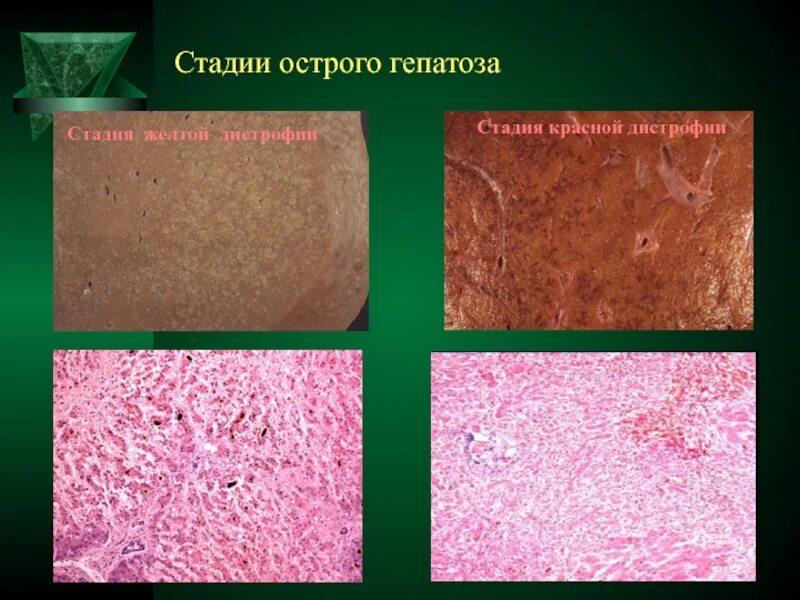 Степени гепатоза. Стадии острого гепатоза. стадии острых гепатозов. токсическая дистрофия печени красная стадия. желтая дистрофия печени макро.