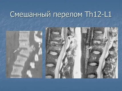 Перелом l 2
