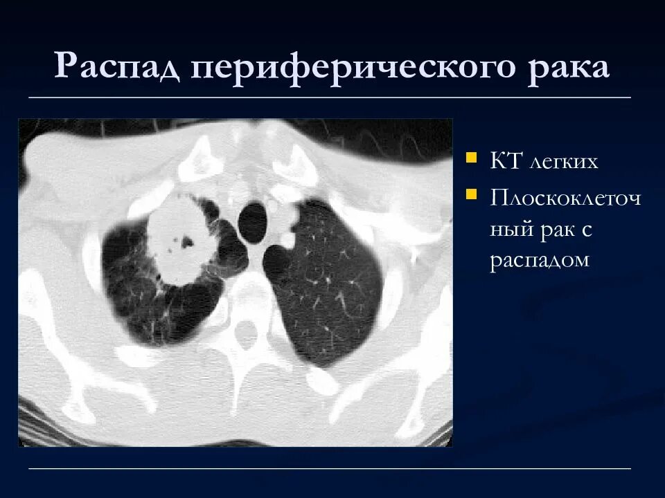 Периферическое образование легких на кт. Периферическая карцинома легких кт.