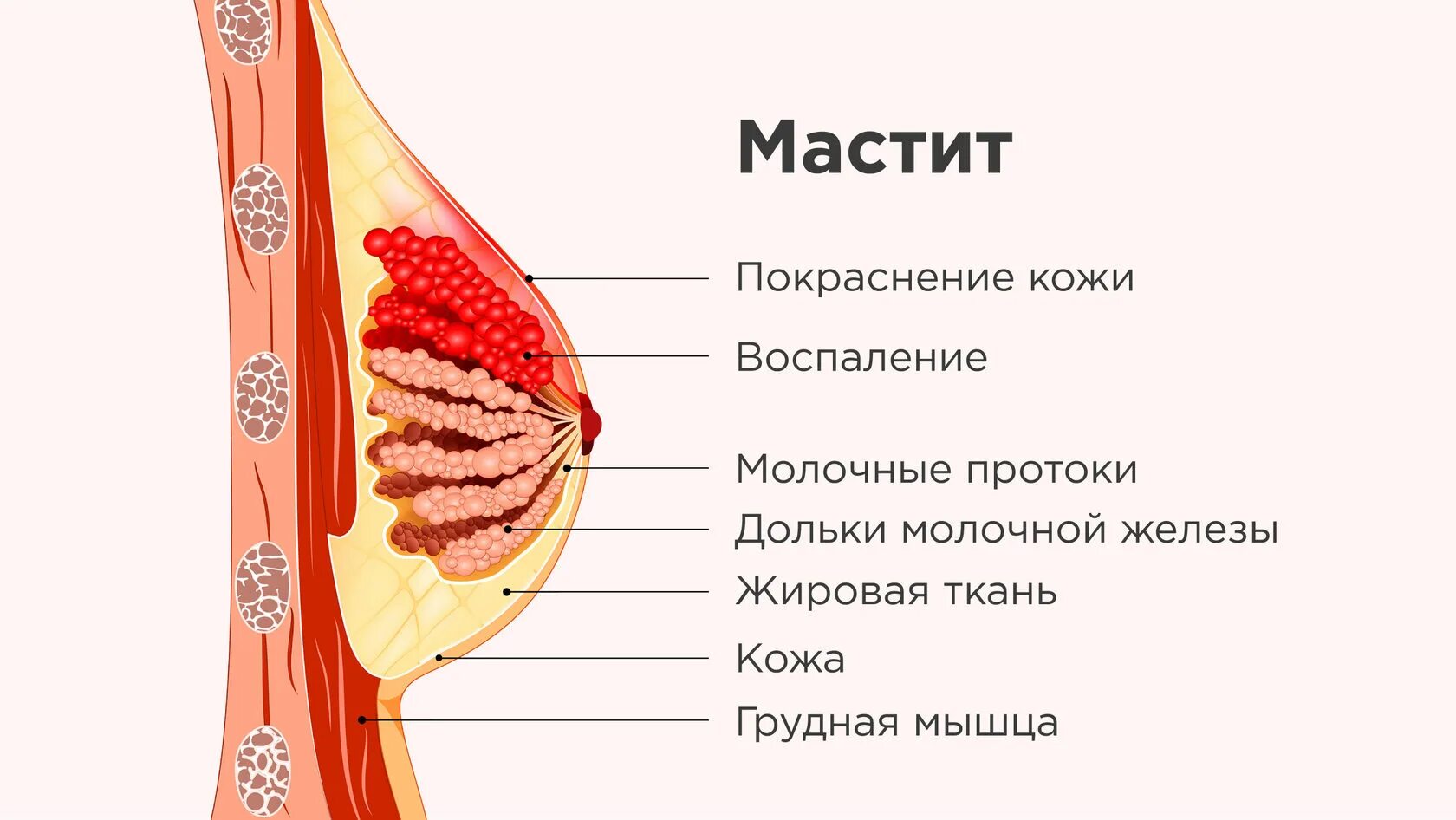 Что такое лактостаз. Что такое лактостаз