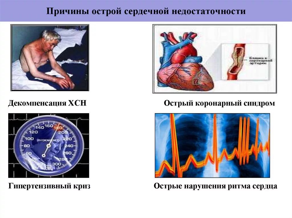 Острая сердечно-сосудистая недостаточность причины. Острая сердечная недостаточность причины. Причины острой сердечной недостаточности. Острая недостаточность сердца причины. Острое сердечное нарушение