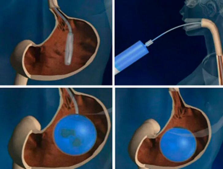 Внутрижелудочный баллон для похудения. Баллон в желудок для похудения. Баллончик в желудок для похудения. Шарик в желудок для похудения. Как уменьшить желудок без операции