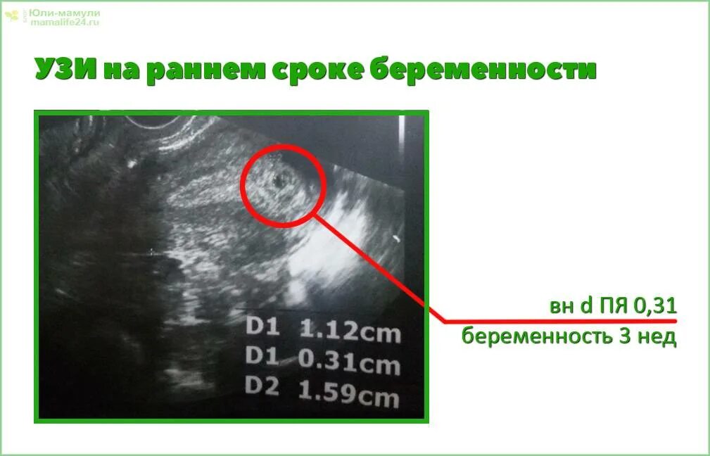 УЗИ беременности на ранних. УЗИ на первых сроках беременности. 2 недели видно на узи