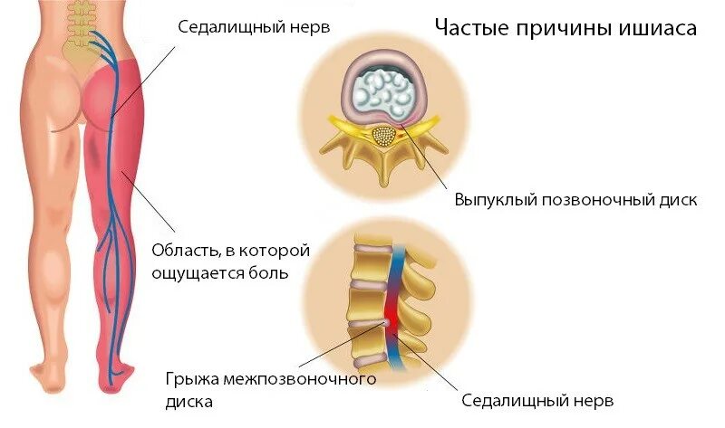 Боли в спине седалищный нерв. Болевые синдромы при воспалении седалищного нерва. Проекция седалищного нерва. Люмбалгия компрессионные синдромы. Грыжа позвоночника защемление нерва.