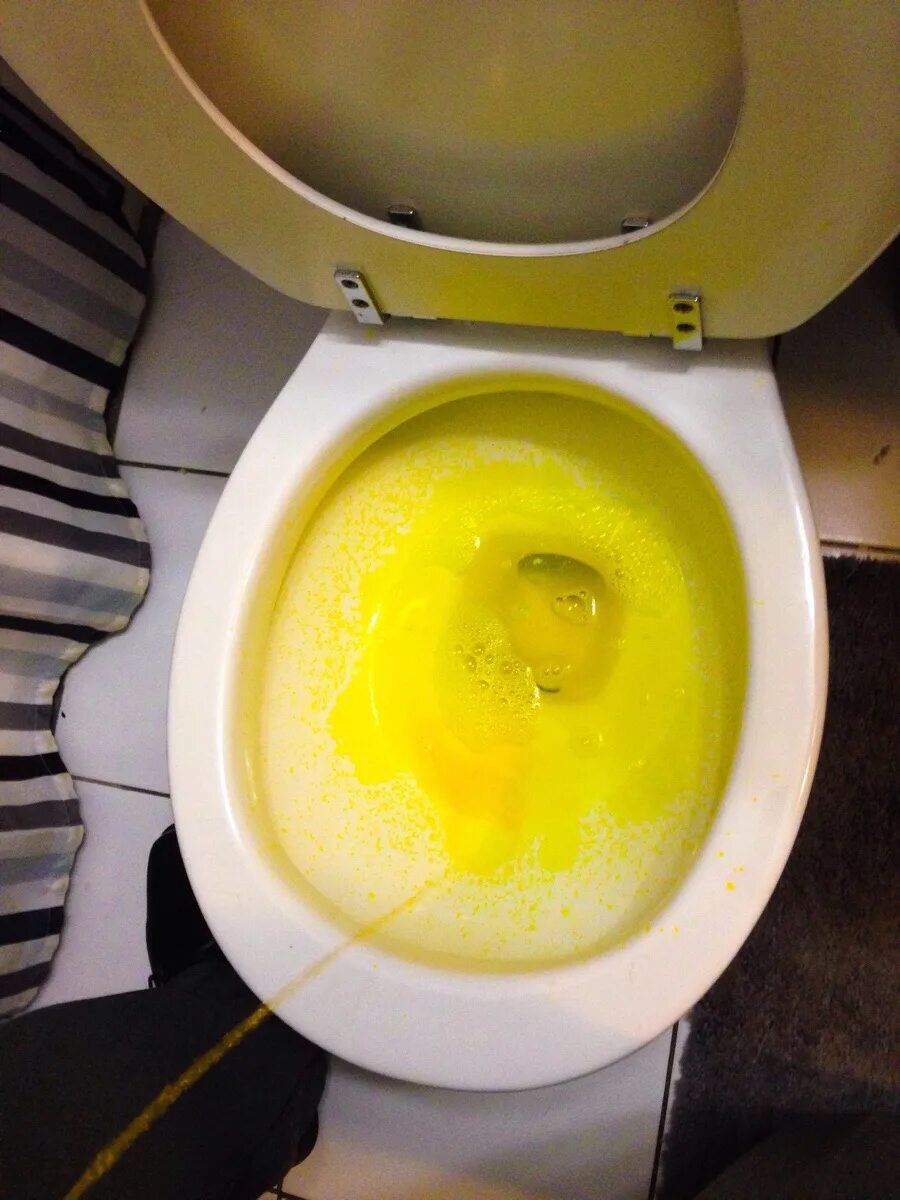 Почему блюешь водой. Желтая моча. Ярко желтая моча. Насыщенно желтая моча. Мочеирку жёлтого цвета.