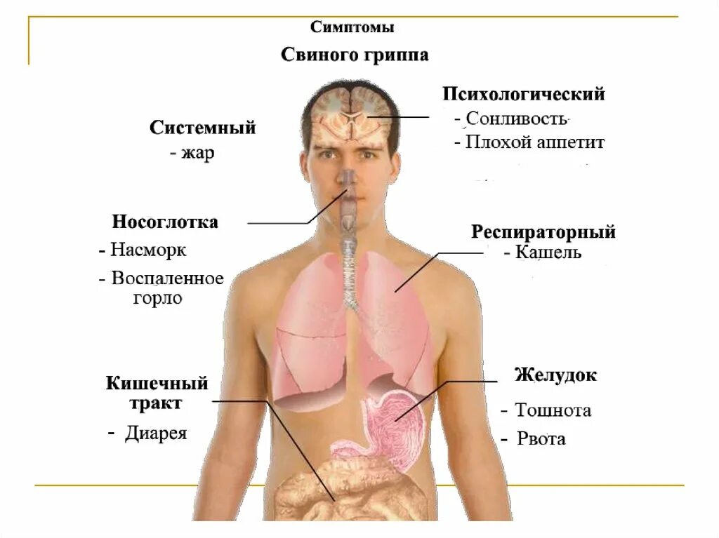 Спин грипп. Свиной грипп. Проявление свиного гриппа. Свиной грипп симптомы. Симптомы свинячего гриппа.