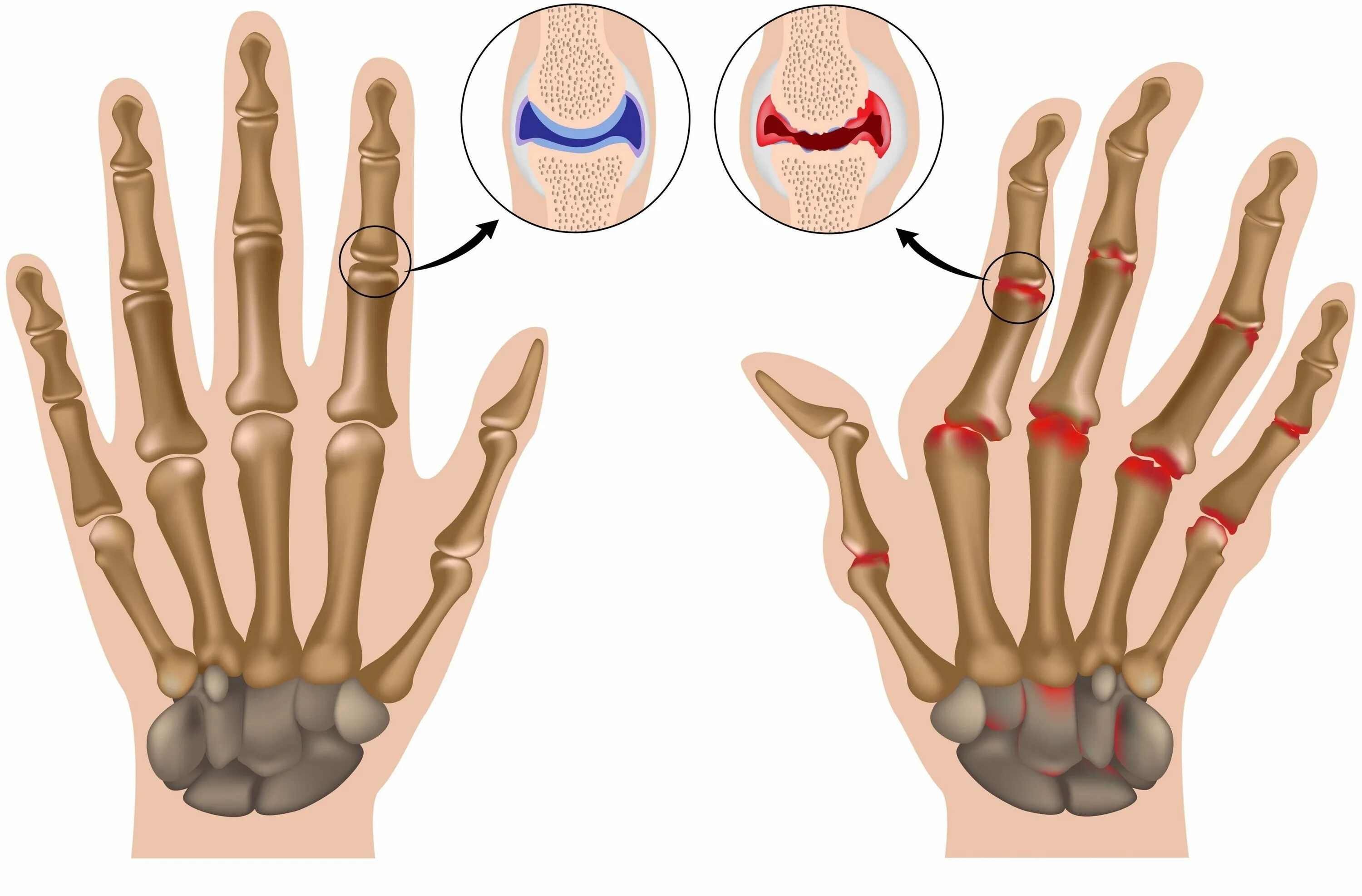 Почему болит кость пальца. Ревматоидный артрит суставов кисти. Посттравматический артроз кисти. Посттравматический артроз пальцев кисти.