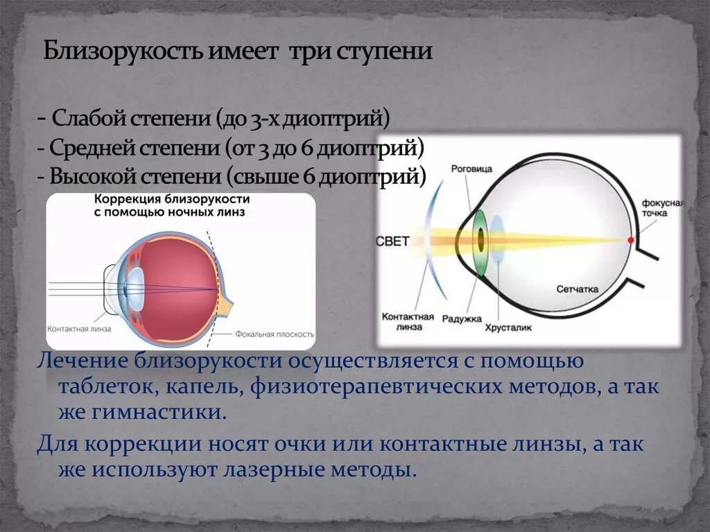 Миопия 0.5 диагноз. Миопия слабой степени. Близорукость слабой степени. Миопия слабой средней степени. Зрение 1 это сколько