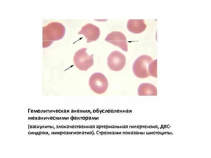 Гемолитическая анемия акантоциты. Гемолитическая анемия мазок крови. Кровь при гемолитической анемии. Гемолиз эритроцитов гистология.