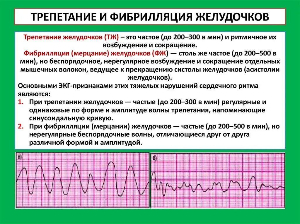 Синусовый ритм изменения миокарда. Фибрилляция и трепетание предсердий на экг. фибрилляция желудочков сердца на экг. трепетание предсердий и желудочков на экг. фибрилляция предсердий мерцательная аритмия экг.