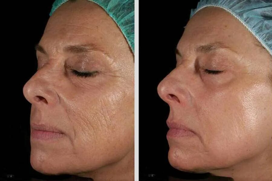 Омоложение лазером до и после. Фотоомоложение м22 розацеа. фракционный фототермолиз м22. лазерная наноперфорация растяжек. фракционный лазерный термолиз.