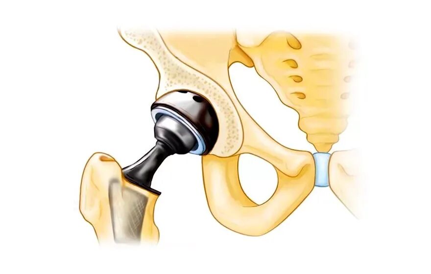 Замена сустава шейки бедра. Эндопротез ТБС. Ревизионное эндопротезирование тазобедренного сустава. Эндопротезирование тазобедренного сустава рисунок. Эндопротезирование тазобедренного сустава операция.