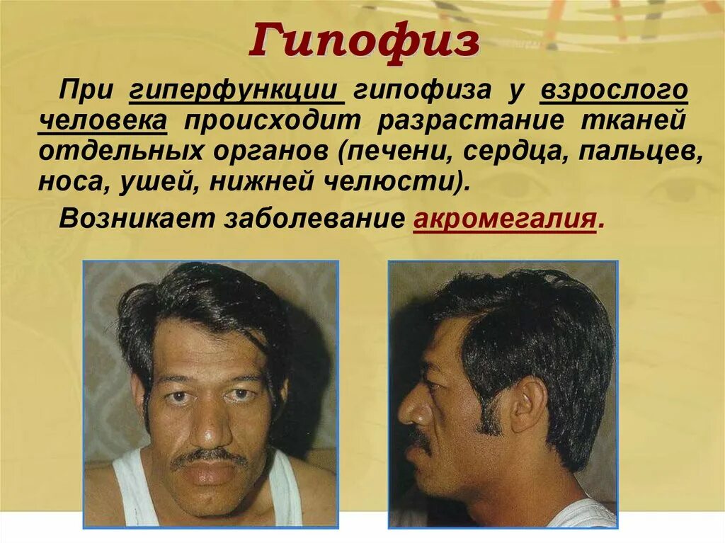 Гипофиз гиперфункция. При гиперфункции гипофиза. гиперфункция гипофиза акромегалия. гиперфункция гипофиза болезнь. гиперфункция гипофиза у взрослых.
