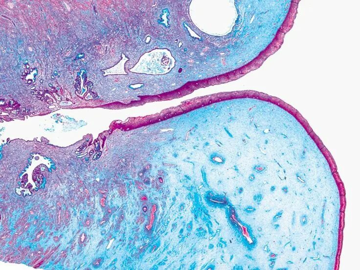 Эктопия шейки кольпоскопия. Кондиломатозный цервицит. Цервикс. Цервикс. Эктопия цервикального эпителия.