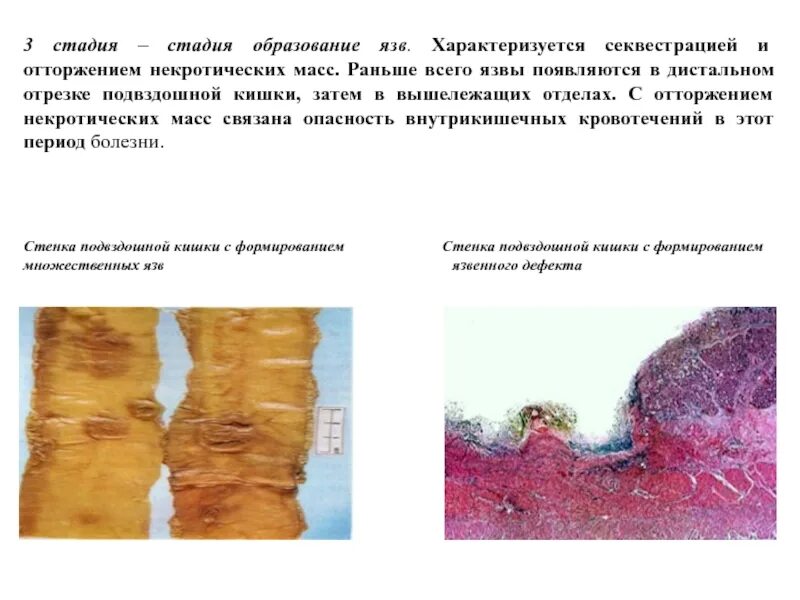 Фазы язвы. Некротический гастрит патанатомия. стадии образования язвы.