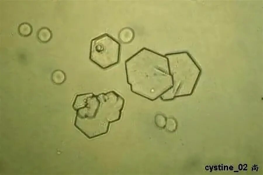 Повышен цистин в моче. Кристаллы цистина в моче микроскопия. Цистин в моче микроскопия. Цистин микроскопия. Кристаллы цистеина в моче.