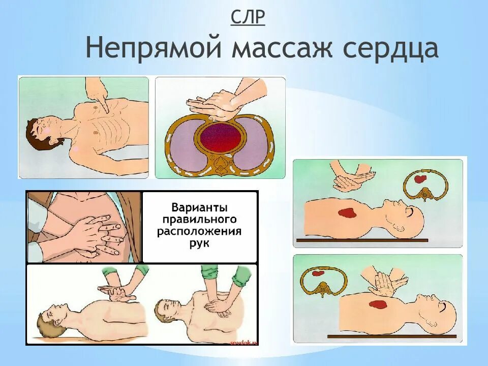 Начал делать массаж сердца. Непрямой массаж сердца иллюстрация. расположение рук при непрямом массаже сердца. искусственное дыхание и непрямой массаж сердца.